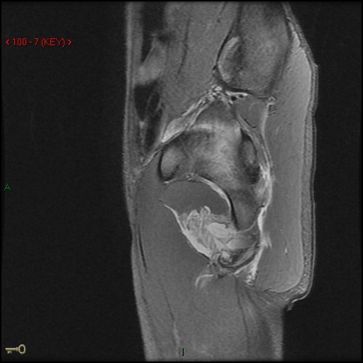 Figure 5 for case Ischial tuberosity ( RID2550 ) avulsion